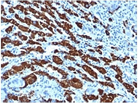 <p>IHC staining of human hepatocellular carcinoma tissue with <a href="../tds/hep-par-1-antibody-hepatocyte-paraffin-1-och1e5-v2341" target="_blank" rel="noopener">Hep Par 1 antibody</a> (clone OCH1E5). HIER: boil tissue sections in pH 9 10mM Tris with 1mM EDTA for 20 min and allow to cool before testing.</p>