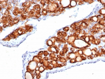<p><strong data-start="0" data-end="54" data-is-only-node="">Thyroid Peroxidase Antibody Thyroid Carcinoma IHC.</strong> Immunohistochemistry analysis of FFPE human thyroid carcinoma tissue using recombinant Thyroid Peroxidase (TPO) Antibody <a href="../tds/recombinant-tpo-antibody-thyroid-peroxidase-tpo6417r-v9282">clone TPO/6417R</a> demonstrates strong HRP-DAB brown membranous and cytoplasmic staining within neoplastic follicular epithelial cells. The staining pattern is consistent with the established expression of TPO, a key enzyme involved in thyroid hormone biosynthesis and follicular cell function. This image highlights thyroid epithelial differentiation and supports studies of thyroid biology, endocrine regulation, follicular cell markers, and thyroid neoplasia. HIER: boil tissue sections in pH 9 10mM Tris with 1mM EDTA for 20 min and allow to cool before testing.</p>