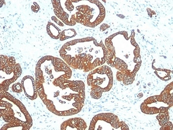 <p>IHC analysis of formalin-fixed, paraffin-embedded human colon carcinoma stained with <a href="../tds/cytokeratin-18-antibody-de-k18-v2671" target="_blank" rel="noopener">KRT18 antibody</a> (clone DE-K18).</p>
