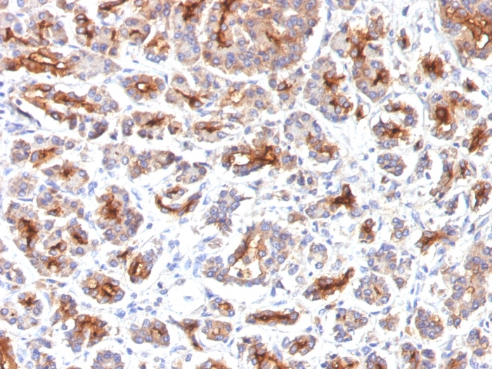 <p><strong data-start="0" data-end="31" data-is-only-node="">CFTR Antibody Pancreas IHC.</strong> Immunohistochemistry analysis of Cystic fibrosis transmembrane conductance regulator / CFTR expression in FFPE human pancreas tissue using <a href="../tds/cftr-antibody-spm176-v3259" target="_blank" rel="noopener">CFTR antibody clone SPM176</a>. HRP-DAB brown staining is observed with apical membranous and luminal accentuation in ductal epithelial cells, while surrounding acinar tissue shows comparatively reduced signal; nuclei are counterstained blue. The staining pattern is consistent with polarized epithelial localization of CFTR in pancreatic duct structures.</p>
