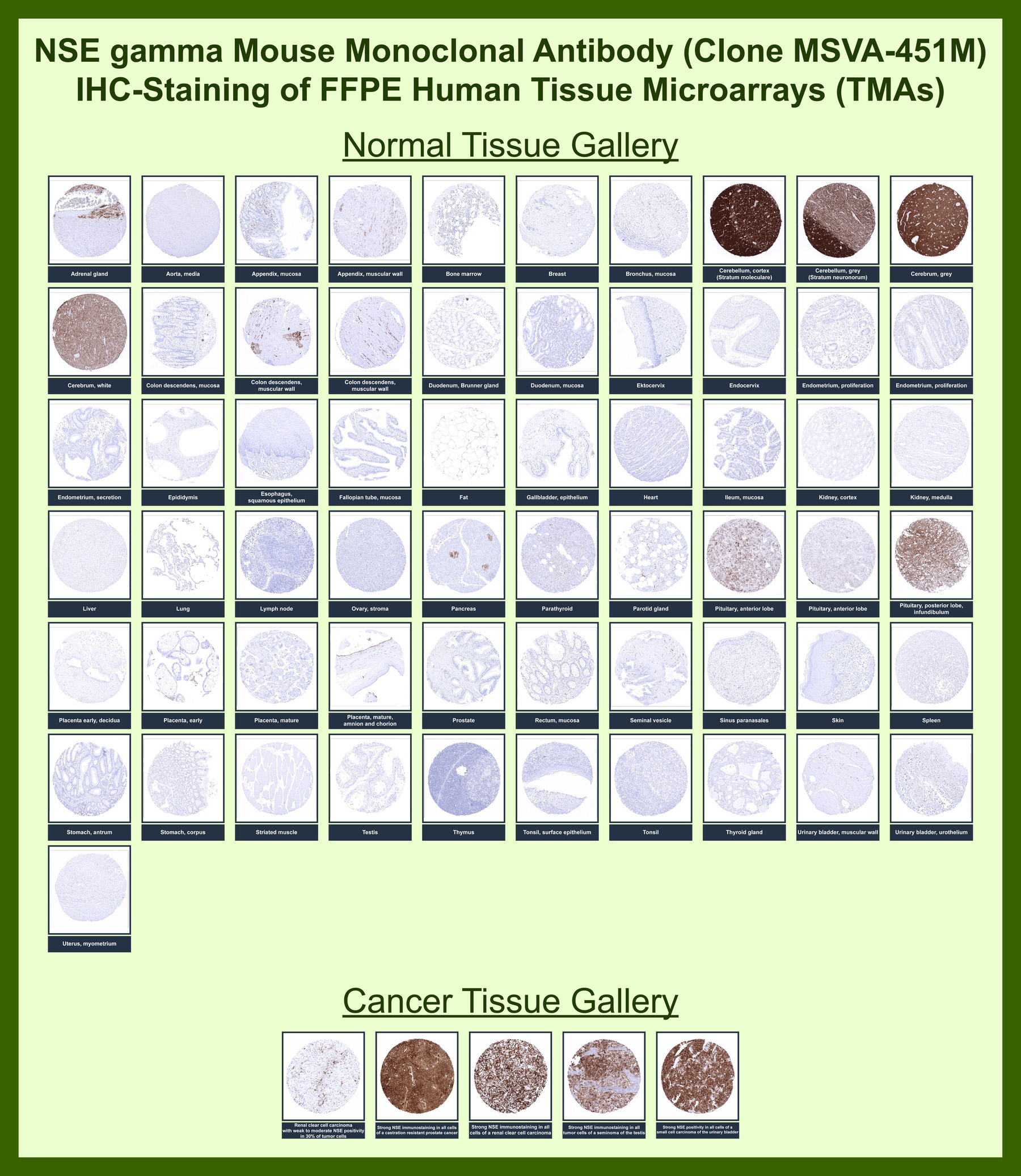 <p><strong data-start="4391" data-end="4466">Gamma-enolase Antibody Tissue Microarray (TMA) Multi-Tissue Expression.</strong> Analysis of Gamma-enolase (ENO2) distribution in FFPE human tissue microarray (TMA) sections using <a href="../tds/gamma-enolase-antibody-for-ihc-eno2-immunohistochemistry-antibody-msva-451m-v5874" target="_blank" rel="noopener">Gamma-enolase Antibody clone MSVA-451M</a> demonstrates strong cytoplasmic staining in neuronal tissues and neuroendocrine cell populations, with minimal staining in non-neural tissues, consistent with known ENO2 expression patterns.</p>
