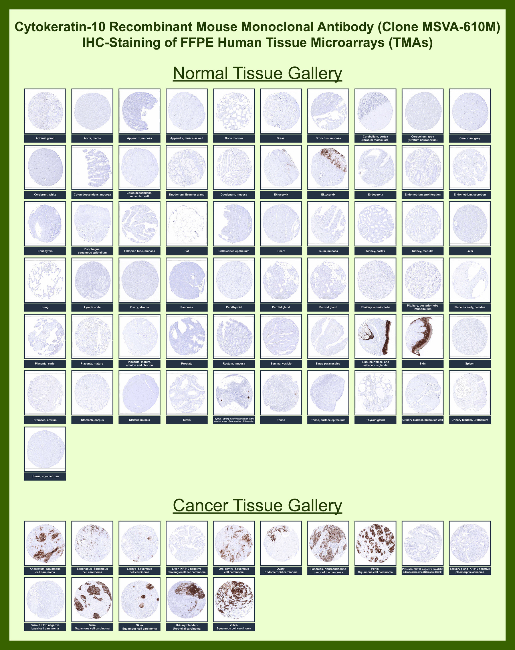 <p><strong data-start="126" data-end="214">Cytokeratin 10 Antibody Tissue Microarray (TMA) epithelial differentiation staining.</strong> Analysis of Cytokeratin 10 (KRT10) expression in FFPE human tissue microarray (TMA) sections using <a href="../tds/cytokeratin-10-antibody-for-ihc-krt10-immunohistochemistry-antibody-msva-610m-v5928" target="_blank" rel="noopener">clone MSVA-610M</a> demonstrates cytoplasmic staining in suprabasal layers of stratified squamous epithelia, highlighting differentiated keratinocyte populations, while basal cells and most non-squamous tissues remain negative. In cancer tissues, staining is observed in squamous cell carcinomas with preserved differentiation, whereas reduced or absent expression is seen in non-squamous and less differentiated tumors. This pattern reflects the role of Cytokeratin 10 as a marker of epithelial maturation and squamous differentiation.</p>