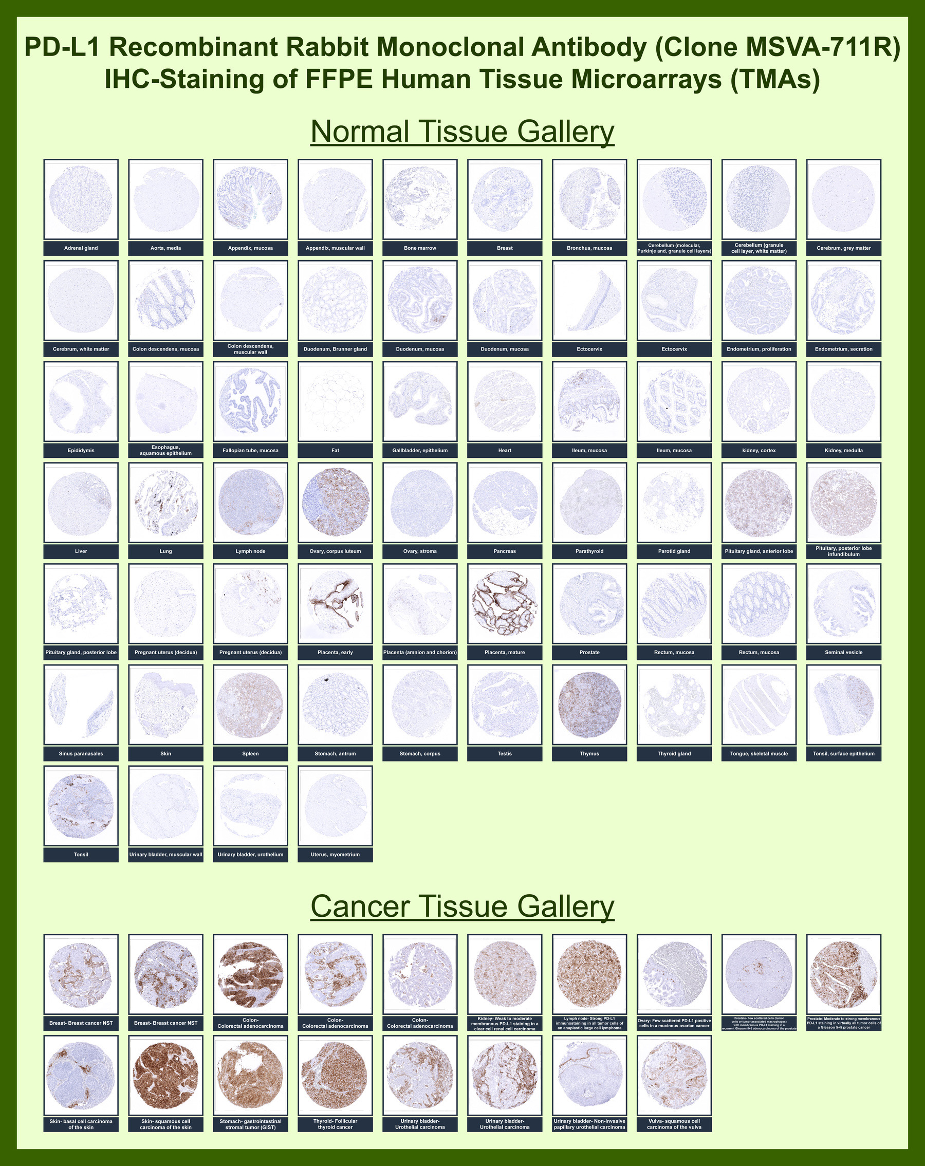<p><strong data-start="4060" data-end="4111">PD-L1 Antibody for IHC Tissue Microarray (TMA).</strong> Immunohistochemistry analysis of PD-L1 (CD274) expression in FFPE human tissue microarrays using recombinant rabbit monoclonal clone MSVA-711R. Tissue Microarray (TMA) staining demonstrates variable membranous HRP-DAB brown signal in tumor cells and tumor-infiltrating immune cells across multiple carcinoma types, while most normal tissues show minimal or inducible expression. Membranous staining in tumor cells and associated immune infiltrates may be evaluated to assess relative PD-L1 expression levels and immune checkpoint activity, supporting comparative analysis of tumor immune context and scoring-based interpretation of expression patterns. The distribution of staining across tissues is consistent with reported CD274 expression profiles in the Human Protein Atlas.</p>