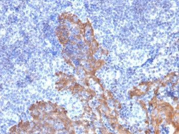 <p>IHC staining of FFPE human tonsil tissue with <a href="../tds/cytokeratin-56-antibody-krt562090-v8493" target="_blank" rel="noopener">KRT5/6 antibody</a> (clone KRT5.6/2090).</p>