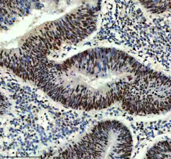 <p><strong data-start="0" data-end="44" data-is-only-node="">PROX1 Antibody Colon Adenocarcinoma IHC.</strong> Immunohistochemistry analysis of FFPE human colon adenocarcinoma tissue using Prospero homeobox protein 1 (PROX1) Antibody demonstrates strong HRP-DAB brown nuclear staining within malignant epithelial cells. The staining pattern is consistent with the established role of PROX1 as a homeobox transcription factor involved in cellular differentiation, developmental regulation, and lineage specification. Nuclear localization highlights the transcriptional activity of PROX1 in tumor cell populations and supports its study in developmental biology, cancer progression, and lymphatic endothelial research. HIER: boil tissue sections in pH8 EDTA for 20 min and allow to cool before testing.</p>