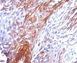 <p>Cytokeratin 17 IHC Antibody Cervical Carcinoma. Immunohistochemistry analysis of FFPE human cervical carcinoma tissue using Cytokeratin 17 IHC Antibody clone <a href="../tds/cytokeratin-17-antibody-ctkn17-1-v7128">CTKN17-1</a> demonstrates strong HRP-DAB brown cytoplasmic staining in malignant epithelial cell populations. The staining pattern is consistent with the established expression of Cytokeratin 17 / CK17 / KRT17 in stratified epithelial tissues and proliferative epithelial-derived malignancies, highlighting tumor-associated keratin intermediate filament organization and basal-like epithelial differentiation. Heat-induced epitope retrieval was performed by boiling tissue sections in pH 9 10mM Tris with 1mM EDTA for 10-20 minutes followed by cooling at room temperature prior to antibody incubation.</p>