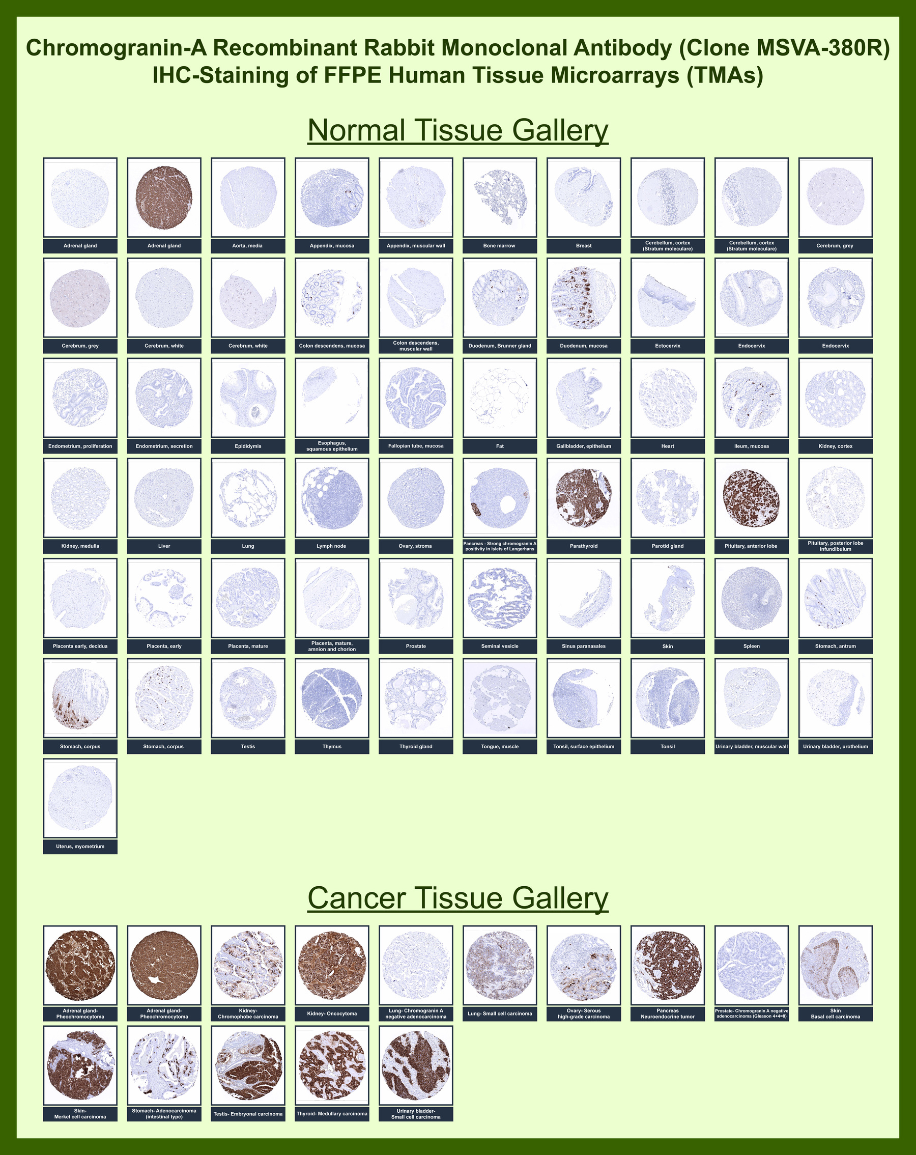 <p><strong data-start="0" data-end="56" data-is-only-node="">Chromogranin A Antibody IHC Tissue Microarray (TMA).</strong> Immunohistochemistry analysis of Chromogranin A / CHGA expression across formalin-fixed, paraffin-embedded human normal and cancer tissue microarrays using Chromogranin A antibody <a href="../tds/chga-antibody-for-ihc-chromogranin-a-msva-380r-v6063">clone MSVA-380R</a>. Tissue microarray (TMA) staining with HRP-DAB brown chromogen demonstrates strong granular cytoplasmic localization in neuroendocrine cell populations, including adrenal medulla, pancreatic islets, and scattered enteroendocrine cells of the gastrointestinal tract, while most non-neuroendocrine tissues show minimal background signal. Across cancer tissue arrays, robust cytoplasmic staining is observed in neuroendocrine tumors such as pheochromocytoma, small cell carcinoma, medullary thyroid carcinoma, and pancreatic neuroendocrine tumor, whereas non-neuroendocrine malignancies remain largely negative. Evaluation across large TMA panels enables consistent comparison of CHGA expression patterns across diverse tissue types, supporting its role as a neuroendocrine marker.</p>