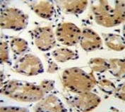 FAT10 Antibody Human Stomach Carcinoma IHC. IHC staining of FFPE human stomach carcinoma tissue with FAT10 antibody demonstrated moderate to strong cytoplasmic staining in malignant epithelial cells, consistent with the expression pattern of FAT10 (Ubiquitin D, UBD), a ubiquitin-like modifier involved in proteasomal degradation, immune regulation, and inflammatory signaling. FAT10 expression is induced by pro-inflammatory cytokines including interferon-Î³ and TNF-Î± and has been reported to be elevated in several human malignancies, where it may contribute to tumor progression, altered protein homeostasis, and immune responses within the tumor microenvironment. The observed staining supports the utility of FAT10 Antibody for studies of cancer biology, inflammation, and ubiquitin-like protein conjugation. Immunohistochemistry was performed on formalin-fixed, paraffin-embedded human stomach carcinoma tissue.