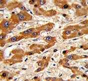 IHC analysis of FFPE human hepatocarcinoma stained with Bax antibody