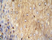Beta-Actin antibody immunohistochemistry analysis in formalin fixed and paraffin embedded human esophageal carcinoma.