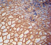 CD44 Antibody Esophagus Carcinoma IHC. Immunohistochemistry analysis of CD44 / CD44 antigen expression in FFPE human esophagus carcinoma tissue using mouse monoclonal antibody clone Hermes-3. Strong membranous HRP-DAB brown staining is observed in malignant epithelial cells, outlining cell borders and highlighting cell surface localization consistent with CD44 expression. The staining pattern demonstrates cohesive tumor architecture and supports its use for evaluating epithelial organization and CD44-associated cell surface interactions in esophageal carcinoma tissue. Heat induced epitope retrieval was performed by boiling tissue sections in pH 9 10mM Tris with 1mM EDTA for 20 min followed by cooling at RT before testing.
