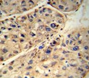 ABCD1 antibody immunohistochemistry analysis in formalin fixed and paraffin embedded human hepatocarcinoma.