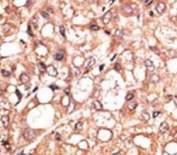 LSD1 Antibody Hepatocarcinoma IHC. Immunohistochemistry analysis of FFPE human hepatocarcinoma stained with the LSD1 antibody.