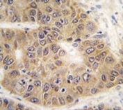 IHC analysis of FFPE human hepatocarcinoma tissue stained with SUMO4 antibody