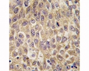 IHC analysis of FFPE human hepatocarcinoma tissue stained with AFP antibody