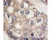 AFP Antibody Hepatocarcinoma IHC. Immunohistochemistry analysis of FFPE human hepatocarcinoma tissue stained with AFP antibody.