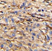 IHC analysis of FFPE human hepatocarcinoma stained with Nestin antibody