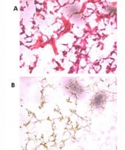 (A) H&E staining of frozen human ovarian cancer tissue with UCH37 antibody at 1:250. (B) 60X magnification.