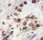 IHC testing of KLF4 antibody and FFPE human prostate carcinoma
