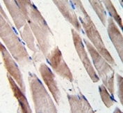 Desmin antibody staining of human hepatocarcinoma tissue