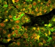 CD38 Antibody for IF human hepatocarcinoma tissue. Immunofluorescence analysis of CD38 / plasma cell marker expression in paraffin-embedded human hepatocarcinoma tissue using a CD38 antibody. Green fluorescence (FITC) highlights CD38 expression with predominantly membranous and cytoplasmic signal, while nuclei are counterstained with propidium iodide (red). The staining demonstrates localization of CD38-positive cells within the tumor microenvironment with clear contrast between fluorescent signal and nuclear regions.