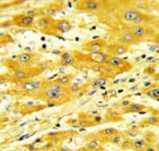 CD36 Antibody Hepatocarcinoma IHC. Immunohistochemical staining of FFPE human hepatocarcinoma demonstrates CD36 expression using a CD36 antibody. CD36, also known as Fatty Acid Translocase, is a multifunctional scavenger receptor that mediates long chain fatty acid uptake and contributes to lipid metabolism, cellular energy homeostasis, and tumor progression. Prominent membranous and cytoplasmic staining is observed in malignant hepatocytes, consistent with the increased fatty acid utilization and metabolic reprogramming associated with hepatocellular carcinoma. These results support the utility of CD36 Antibody for studies of cancer metabolism, lipid transport, and scavenger receptor biology.