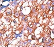 Phospho-ERBB4 (pY1162) Antibody Hepatocarcinoma Tissue IHC. Immunohistochemistry analysis of FFPE human hepatocarcinoma stained with Phospho-ERBB4 (pY1162) Antibody demonstrates HRP-DAB brown membranous and cytoplasmic staining in tumor cells, consistent with activated HER4 / ERBB4 signaling, while surrounding non-tumor regions show reduced background; nuclei are counterstained blue.