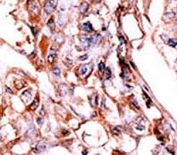 Phospho-HER4 (pY1188) Antibody Hepatocarcinoma Tissue IHC. Immunohistochemistry analysis of FFPE human hepatocarcinoma stained with Phospho-HER4 (pY1188) Antibody demonstrates moderate HRP-DAB brown cytoplasmic and membranous staining in tumor cells, consistent with regulated ERBB4 / HER4 phosphorylation, while surrounding tissue exhibits lower background; nuclei are counterstained blue.