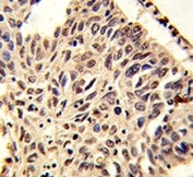 H4 Antibody Methyl-Lys20 Specific IHC. Immunohistochemistry analysis of histone H4 lysine 20 methylation in FFPE human lung carcinoma tissue using H4 Antibody Methyl-Lys20 Specific. Nuclear HRP-DAB brown staining is observed in tumor epithelial cells, consistent with chromatin-associated localization of methylated histone H4 (HIST1H4). The staining pattern highlights nuclear compartmentalization with minimal cytoplasmic background, supporting detection of chromatin compaction-associated histone modification.