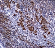 S100B antibody immunohistochemistry analysis in formalin fixed and paraffin embedded human malignant melanoma.