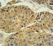 Beta III Tubulin antibody immunohistochemistry analysis in formalin fixed and paraffin embedded human hepatocarcinoma.