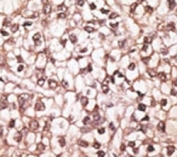 IHC analysis of FFPE human hepatocarcinoma tissue stained with the ABCB4 antibody