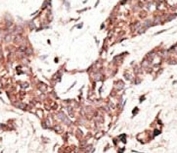 SIRT3 Antibody Breast Cancer IHC. Immunohistochemistry analysis of FFPE human breast carcinoma tissue stained with the SIRT3 antibody.