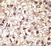 PRKN Antibody Human Hepatocellular Carcinoma IHC. IHC staining of FFPE human hepatocellular carcinoma tissue was performed with PRKN Antibody. Positive PRKN/Parkin staining is observed predominantly in the cytoplasm of tumor cells. This PRKN Antibody demonstrates cellular localization of Parkin RBR E3 ubiquitin ligase in human hepatocellular carcinoma tissue.