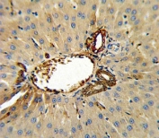 Annexin V antibody IHC analysis in formalin fixed and paraffin embedded human hepatocarcinoma.