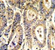 IHC analysis of FFPE human colon carcinoma stained with IGFBP6 antibody