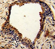 IHC analysis of FFPE human prostate carcinoma with NDRG1 antibody