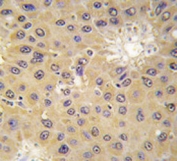 IHC analysis of FFPE human hepatocarcinoma tissue stained with ACAT1 antibody