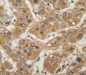 IHC analysis of FFPE human hepatocarcinoma tissue stained with ApoE antibody