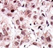 IHC analysis of FFPE human cancer tissue stained with the AXL antibody