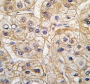 EGF Receptor Antibody Hepatocarcinoma IHC. Immunohistochemistry analysis of FFPE human hepatocarcinoma tissue stained with the EGF Receptor antibody.