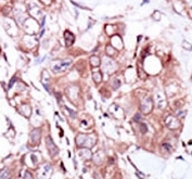 ERBB4 Antibody IHC. Immunohistochemistry analysis of FFPE human breast carcinoma tissue stained with the ERBB4 antibody.