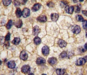 PDGFR Alpha Antibody Prostate Carcinoma IHC. Immunohistochemistry staining of FFPE human prostate carcinoma tissue using PDGFR Alpha Antibody / Receptor Tyrosine Kinase Antibody demonstrates membranous and cytoplasmic HRP-DAB brown staining within malignant epithelial cells. The staining pattern is consistent with expression of PDGFRA, a receptor tyrosine kinase that mediates platelet-derived growth factor signaling and regulates cellular proliferation, migration, differentiation, and survival. PDGFRA signaling contributes to communication between tumor cells and the surrounding microenvironment and has been extensively studied in cancer biology due to its roles in growth factor-mediated signaling and tissue remodeling. The observed staining supports expression of PDGFRA in prostate carcinoma-associated cellular populations.