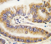 IHC analysis of FFPE human lung carcinoma tissue stained with PTEN antibody