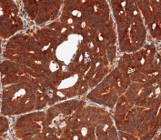 DUSP6 Antibody Human Colon Carcinoma IHC. Immunohistochemical staining of FFPE human colon carcinoma tissue using DUSP6 antibody demonstrates strong and widespread cytoplasmic HRP-DAB brown staining throughout neoplastic gland-forming epithelial cells. The staining pattern is consistent with expression of DUSP6 (Dual Specificity Phosphatase 6), a key negative regulator of ERK/MAPK signaling pathways. DUSP6 modulates intracellular signal transduction by dephosphorylating activated ERK proteins, thereby helping regulate cellular responses to growth factor stimulation, differentiation signals, and proliferative cues. The robust staining observed within malignant epithelial structures supports the role of DUSP6 in maintaining signaling homeostasis within pathways that influence cellular growth and tissue organization. HIER: steam sections in pH 9 EDTA for 20 minutes and allow to cool prior to staining.