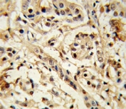 BMI1 Antibody Breast Carcinoma IHC. Immunohistochemistry analysis of FFPE human breast carcinoma stained with BMI1 antibody.