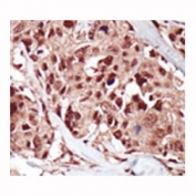 Immunohistochemistry of BRD4 antibody in human breast carcinoma tissue. FFPE human breast carcinoma shows predominantly nuclear HRP-DAB brown staining within tumor epithelial cells, consistent with the known nuclear localization of Bromodomain-containing protein 4 as a chromatin-associated transcriptional regulator. The antibody targets the N-terminal region of BRD4.