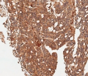 IHC testing of FFPE human colon carcinoma tissue with MCT4 antibody. HIER: steam section in pH6 citrate buffer for 20 min and allow to cool prior to staining.