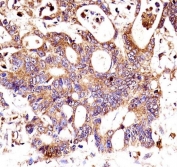 Catenin Beta Antibody Human Colon Carcinoma Immunohistochemistry. IHC testing of FFPE human colon carcinoma tissue with Catenin Beta antibody. HIER: steam section in pH6 citrate buffer for 20 min and allow to cool prior to staining.