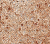 Albumin Antibody Human Liver Tissue IHC. Immunohistochemistry staining testing of FFPE human liver tissue with Albumin antibody. HIER: steam section in pH9 EDTA for 20 min and allow to cool prior to staining.